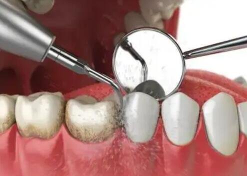 洗牙齿有什么好处和坏处：可以清洁牙齿不过可能会造成牙龈出血