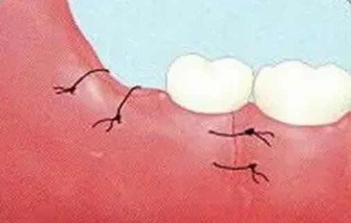 拔智齿后那个洞臭到恶心，牙洞需要多久才能愈合-第2张图片-爱薇女性网